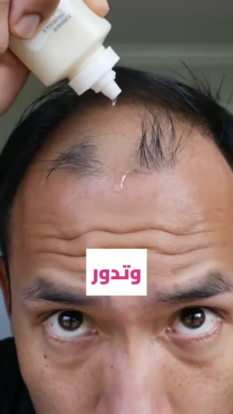 Hair-loss story — AI video ad